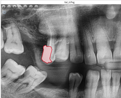 Panoramic Dental X-ray Interpretation