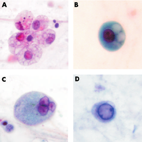 Morphological-changes-of-macrophages-including-A-cytoplasmic-foaminess-B-distinct Morphological-changes-of-macrophages-including-A-cytoplasmic-foaminess-B-distinct